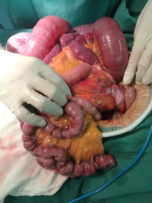 2018年12月第一台急诊开腹手术急性肠梗阻,小肠扭转致