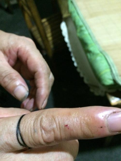 红印被老鼠咬的,这么晚了医院也关门了,要怎么进行清洗,和避免发病