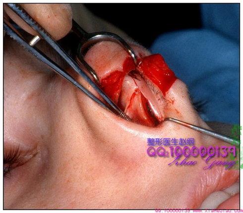 鼻整形手术系列 -鼻中隔整形-2页[原创]{待续……} 整形医生赵纲