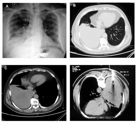 首页 呼吸内科 典型病例 正文  肺纤维瘤是一种罕见的肺间叶组织良性