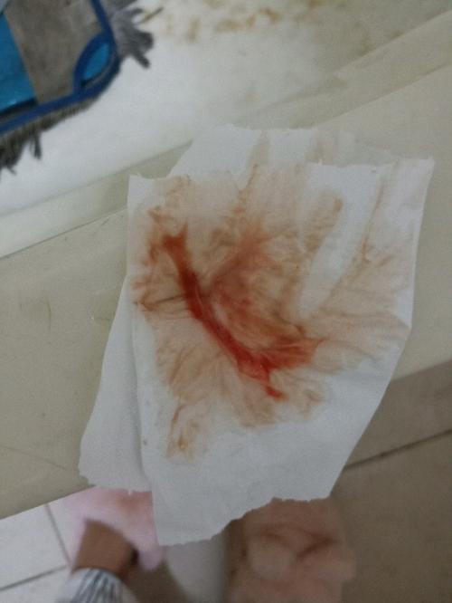 白带带血丝怎么回事(里面有图慎入)