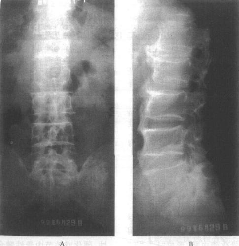 弥漫性特发性骨质增生症
