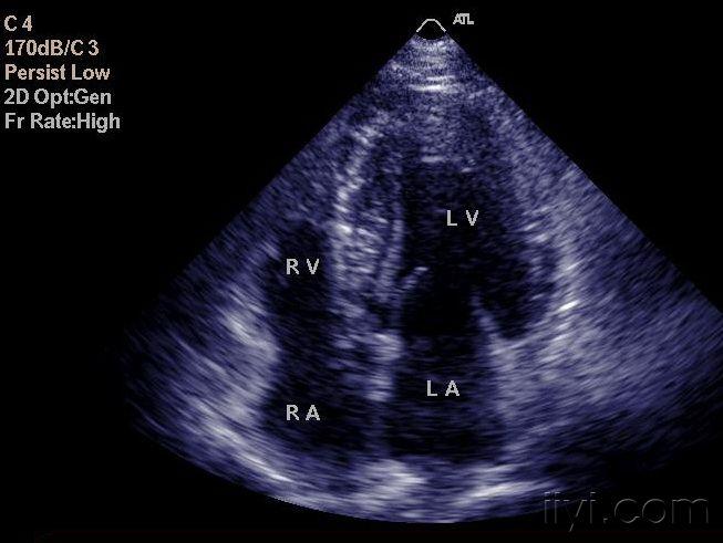 【原创】肥厚性非梗阻型心肌病