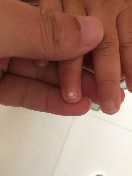 小孩手指甲上有这个白色的是不是有点缺钙啊