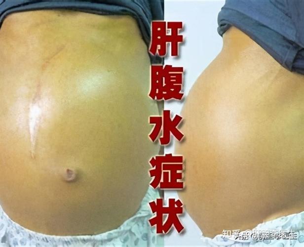 这种情况下的肚子大我们就要考虑有可能出现了腹水,那么肝硬化是腹水