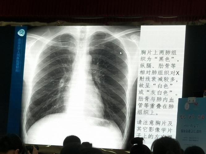 胸片及ct观察picc管