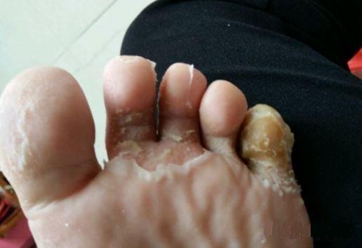 脚底长了像水泡一样的东西很痒怎么办?用什么药|足癣