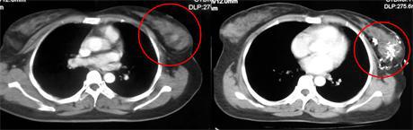 "一针消瘤法"帮助我成功战胜乳腺癌,做完整女人