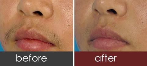 激光脱唇毛