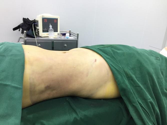 以前在美好尉来做了大腿吸脂,已经恢复了8个月左右了,还是挺满意的真