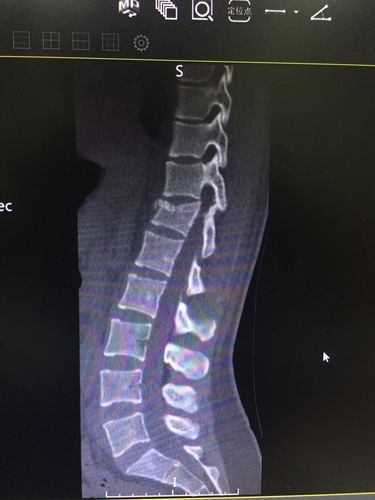 t12椎体压缩性骨折(田欢)