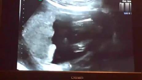 怀孕16周是什么样子 b超下看的真清晰 大概可以看出是个女宝