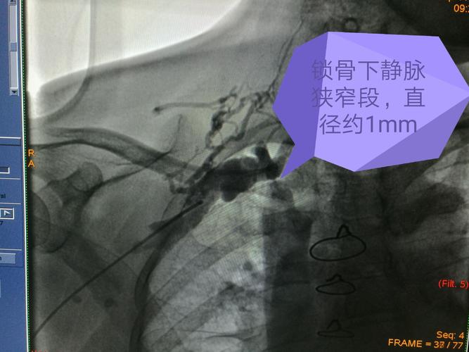 dsa下造影见锁骨下静脉跨第一肋处狭窄