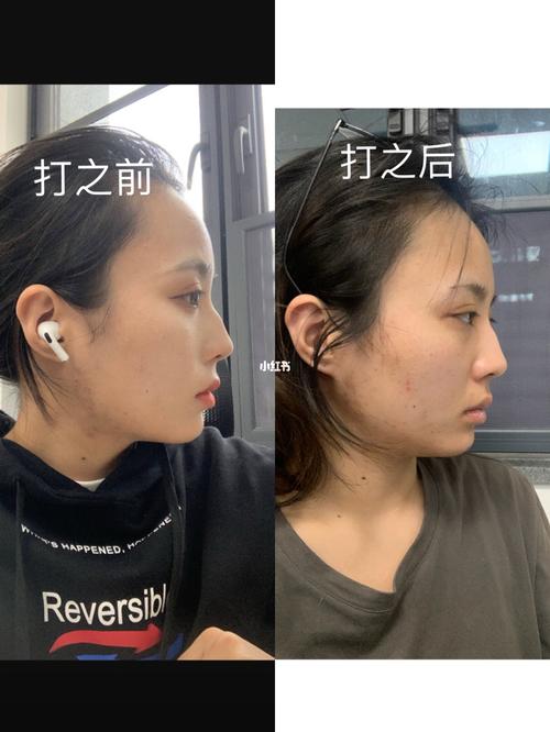 武汉保妥适瘦脸针下颚缘提升 失败 凹陷下垂