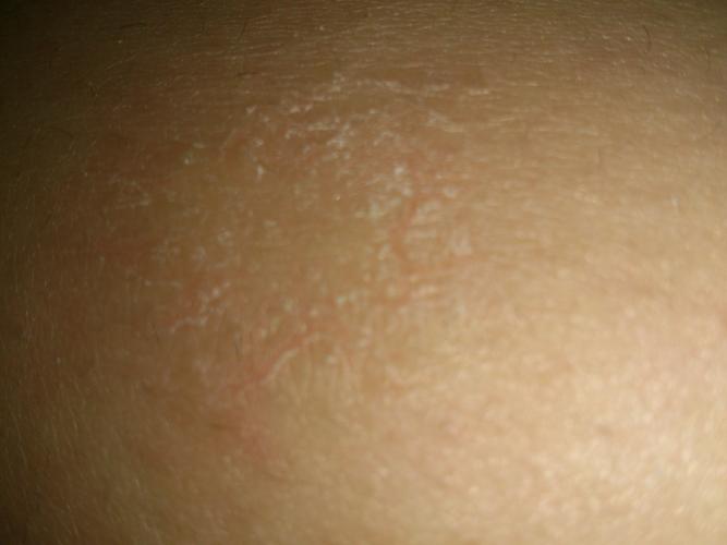 大腿上长了一个癣.不知道是什么,有脱皮迹象