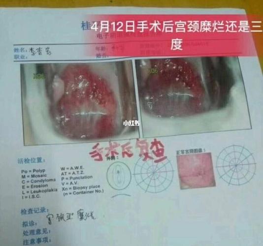 宫颈糜烂三度_宫颈糜烂_广西_医疗健康_医疗健康其他