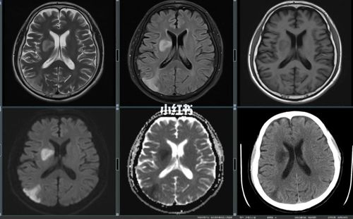医学影像脑梗死中心病灶分析mri与ct对照