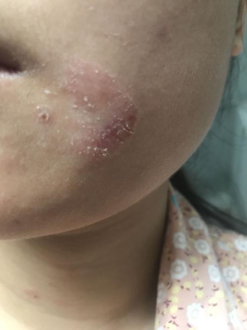 脸上有一块地方老脱皮,红的,还痒