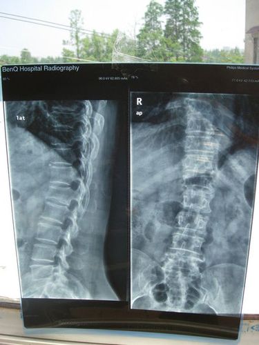 腰椎压缩性骨折(付x光片,ct片)