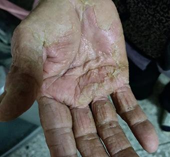 严重脱皮老化的手湿疹图片