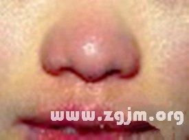 眼圈发黑,红鼻子,口边痣,眼尾痣图解
