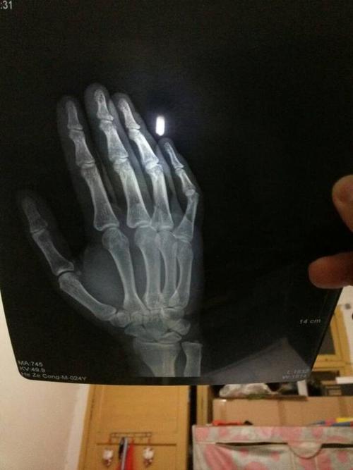 外科 普外科 外伤科 → 我骑车摔了.右手手腕处好像错位了,现在都