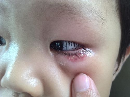 宝宝麦粒肿出脓了还是鼓包怎么办