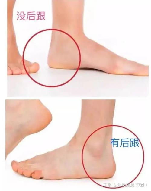 降低,之后就可以通过一些 踝关节的松动术来让跟骨拥有一个正常活动度