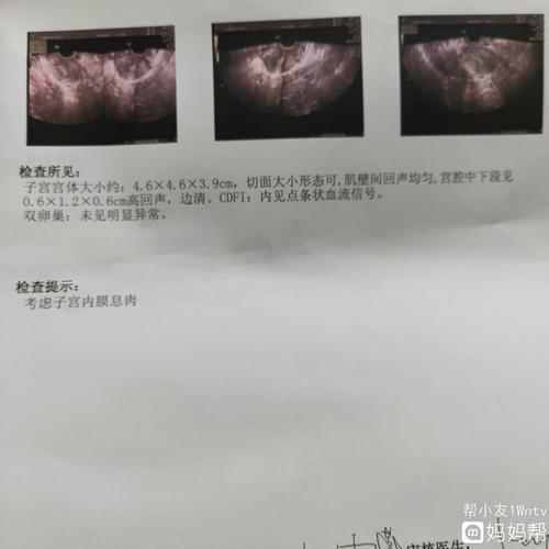 子宫内膜息肉有没有这种情况的姐妹