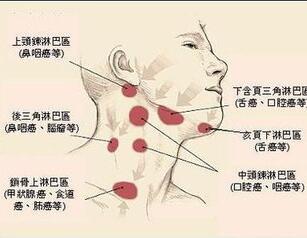 淋巴癌血液检查能查出来?