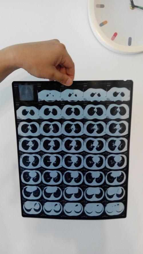 问:这样的ct片,算肺炎吗?求助呀