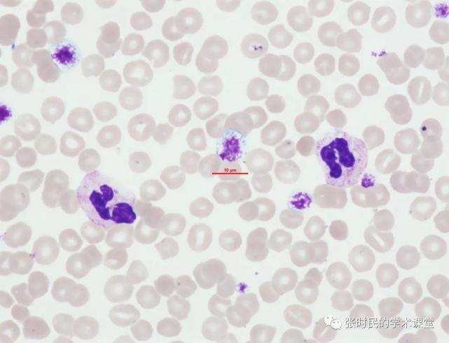 既然血细胞分析仪和cellavision都提示大血小板增多和口型红细胞增多