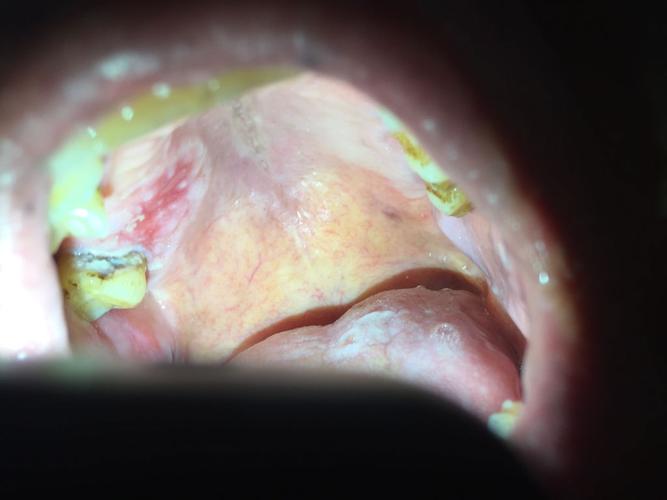 口腔问题,大家看这几张图片,我爷爷的口腔,左上角有大