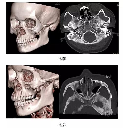 我院口腔科成功开展三切口联合入路颧骨颧弓多发骨折复位固定术
