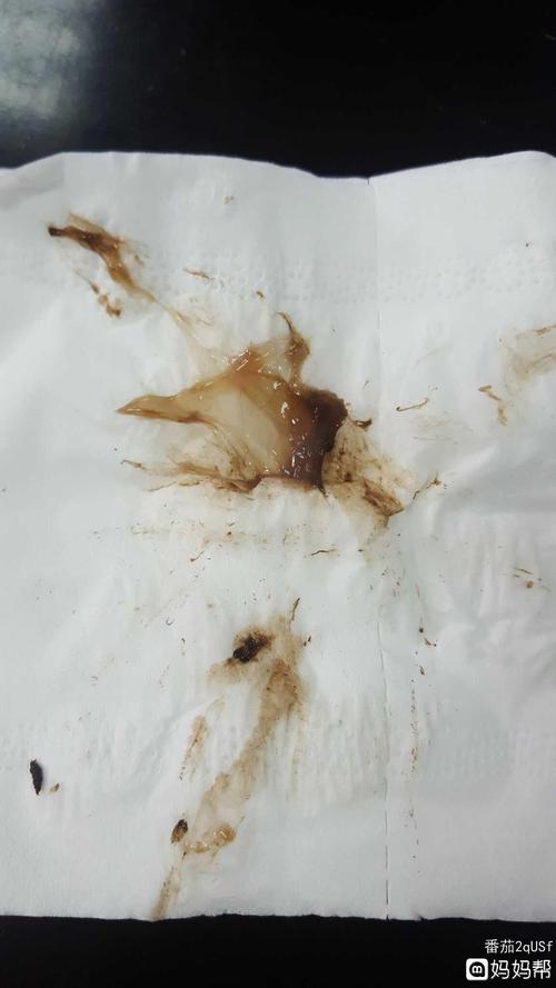 宫外孕可以自己排出来吗?