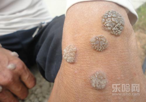 鱼鳞痣怎么形成的 鱼鳞痣的治疗方法