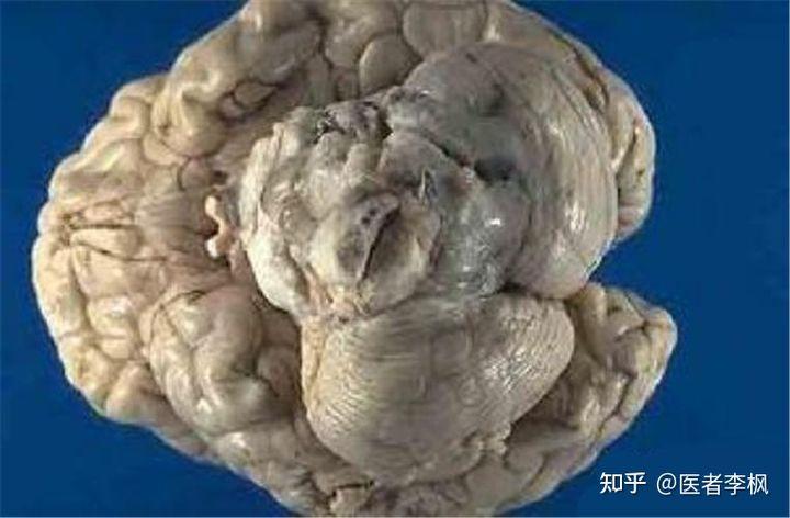 从良性肿瘤到恶性肿瘤要多久?