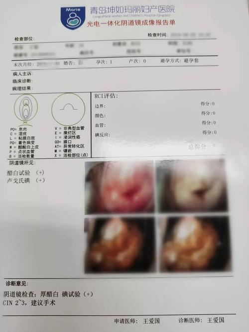 过去一个月,4成体检女性查出宫颈病变,阴道镜检查是诊断宫颈癌前病变