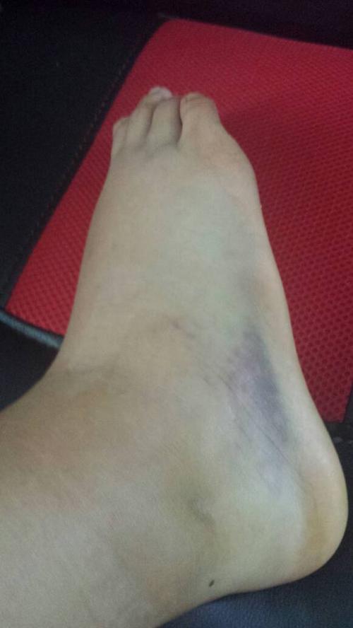 右脚扭伤后脚腕肿胀,去医院开了药和贴了些膏药,脚腕不肿了,但是整个