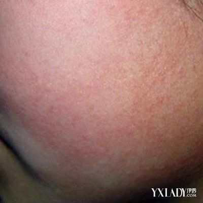 【图】脸上鸡皮肤怎么消除 告诉你四个方法步骤