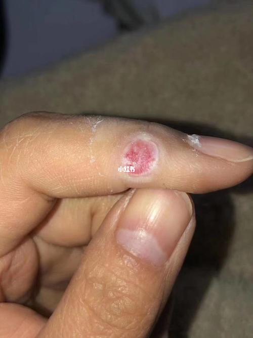 跖疣与鸡眼的区别别弄错你懂吗?