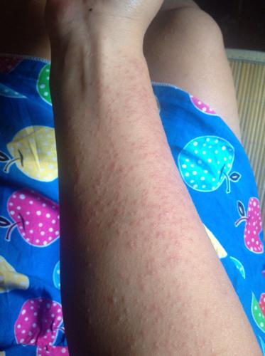 紫外线过敏,怎么办