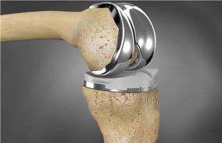 人工关节,你知道多少?