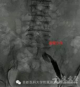 髂静脉压迫综合征