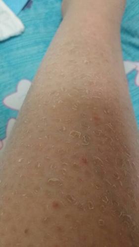 皮肤一直很干燥,尤其小腿部.照片是皮肤现状,请问这会