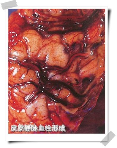 皮质静脉血栓形成(图)