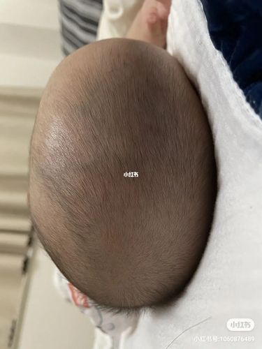 关于舟状头 颅缝早闭 矢状缝早闭的经验交流