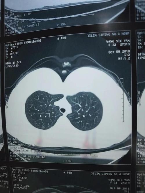 肺部结节一般有哪些症状?一旦发现肺结节,多久复查一次ct好?