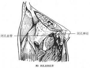 疝,只有局部组织薄弱,如闭孔外肌破裂,向尾侧移位或闭孔膜异常薄弱等