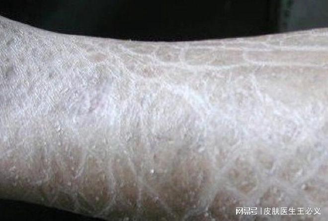 为什么会出现鱼鳞病哪些症状说明是鱼鳞病